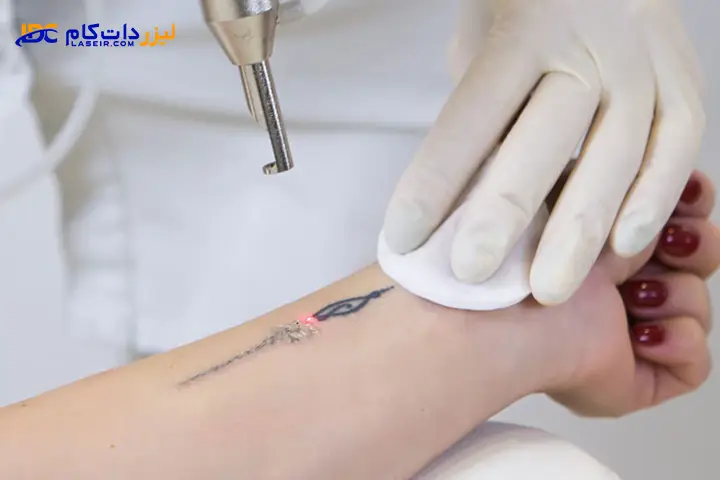 پاک کردن تاتو با لیزر