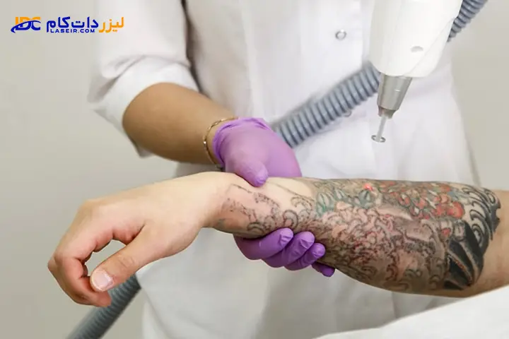 پاک کردن تاتو با لیزر
