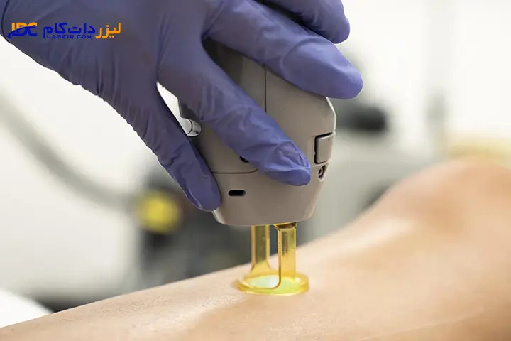اپراتور لیزر موهای زائد