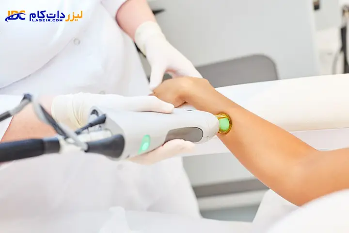 لیزر بهتر است یا اپیلاسیون