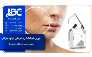 لیزر فرکشنال درمان جای جوش