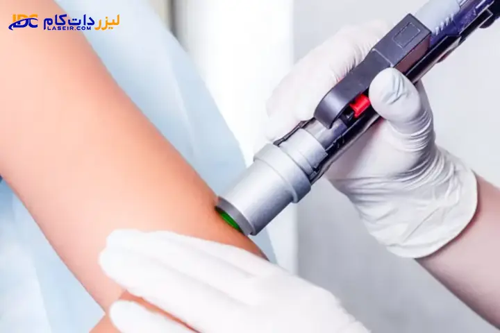 مراقبتهای بعد از لیزر موهای زائد
