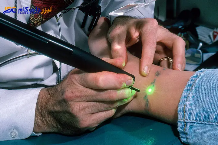 میزان اثربخشی پاک کردن تاتو با لیزر