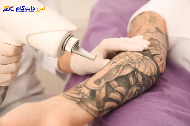 پاک کردن تاتو با لیزر
