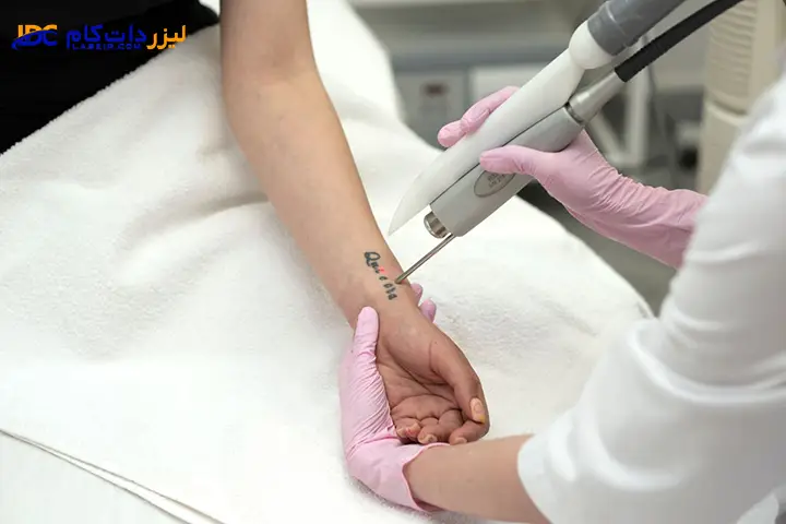 میزان اثربخشی رفع تاتو با لیزر